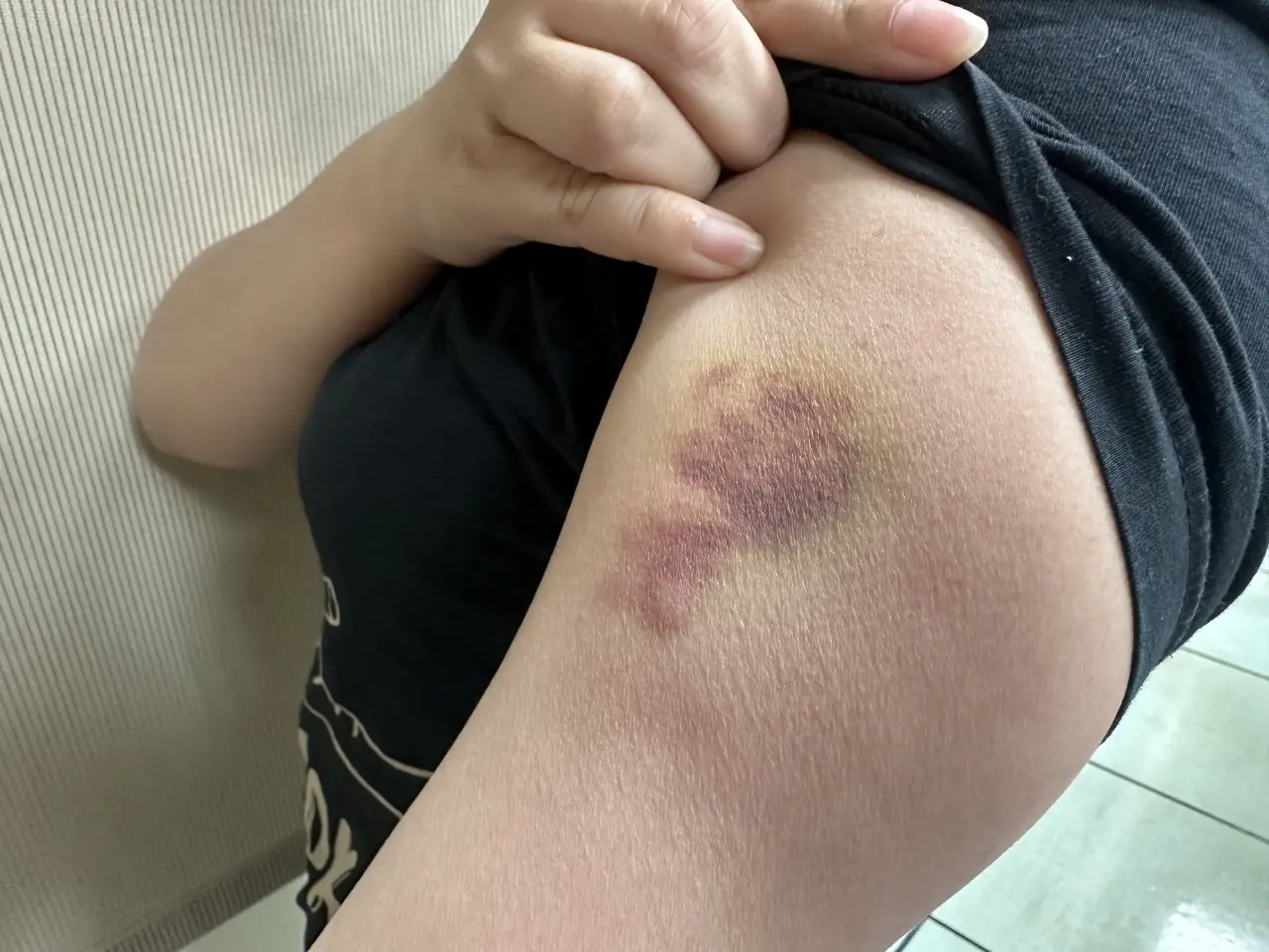 張小姐受傷瘀青。讀者提供