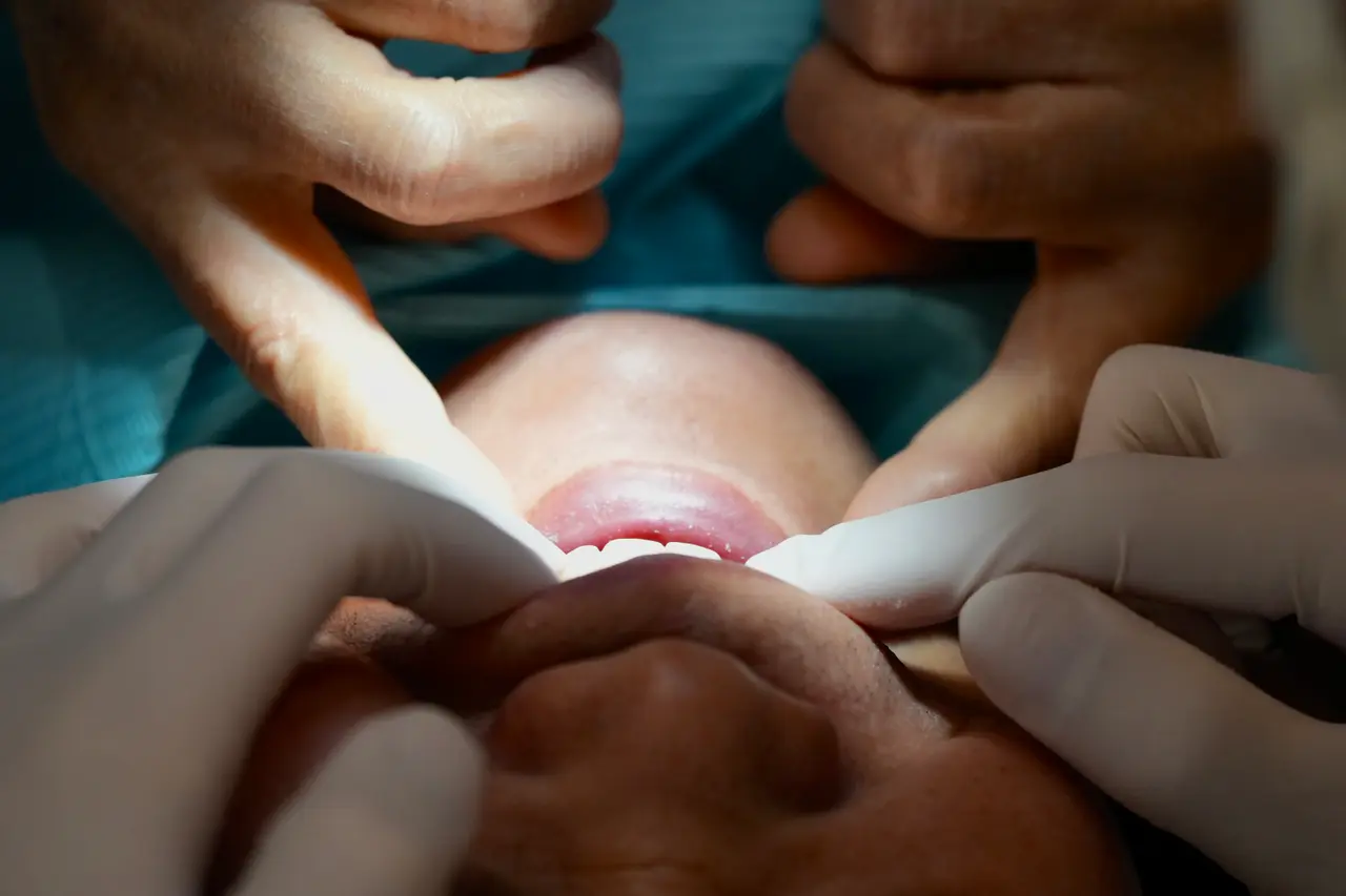 智齒拔2次沒拔成還削骨！她怒告牙醫求償20萬　法院判免賠理由曝光