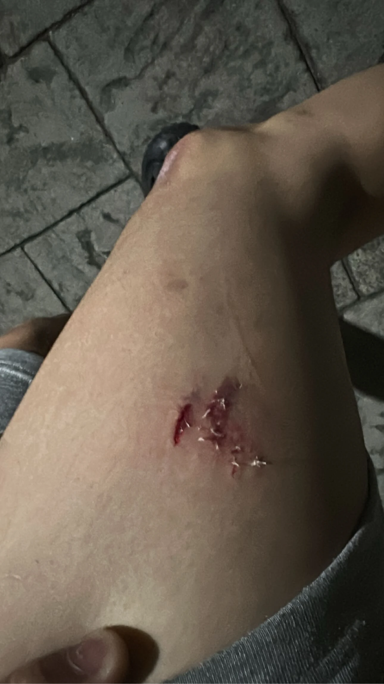 張男出示大腿遭犬隻咬傷傷口。翻攝Threads