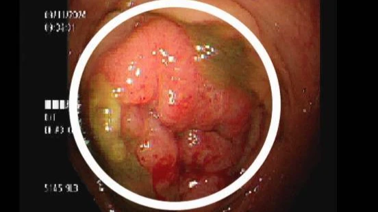 一顆約5公分大的腫瘤在直腸。讀者提供