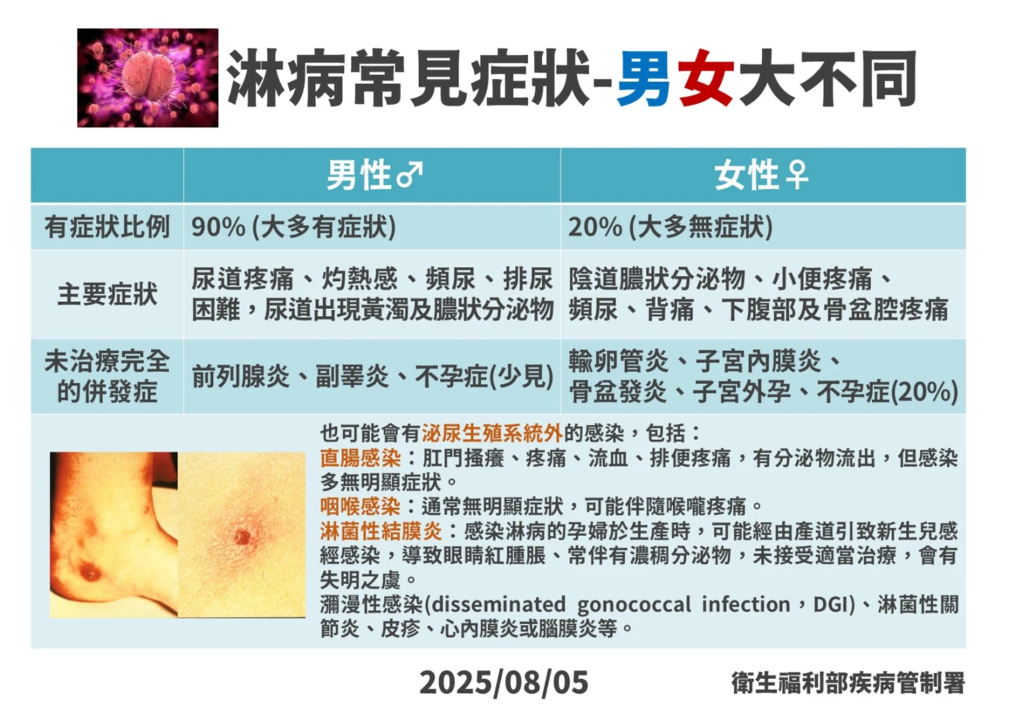 淋病常見症狀,男女大不同。疾管署提供