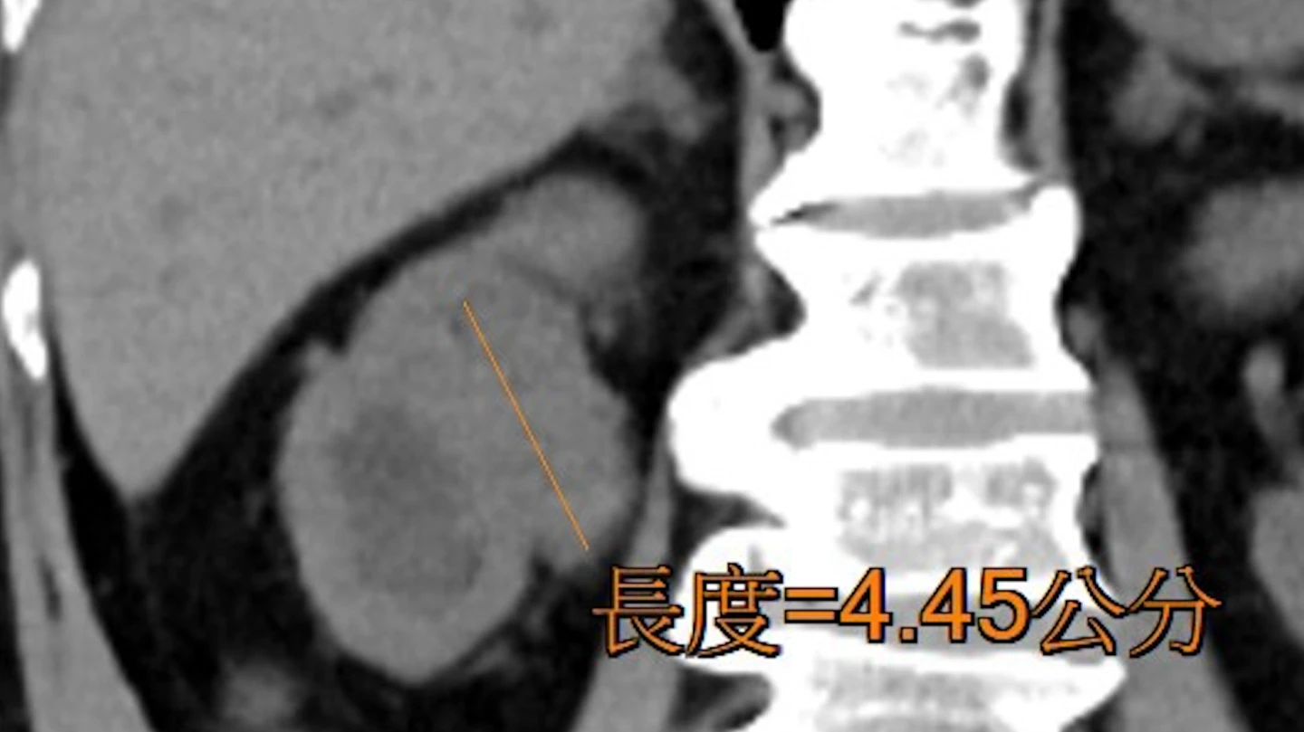 李姓男子長期血尿,主因右側腎臟至輸尿管內,有顆近5公分的大型腫瘤持續出血。高醫岡山醫院提供