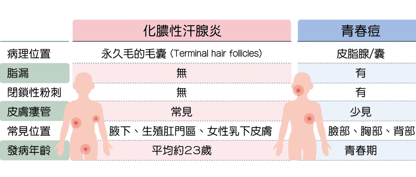 冒痘部位及復發頻率是辨別青春痘或化膿性汗腺炎的關鍵。台灣皮膚科醫學會提供