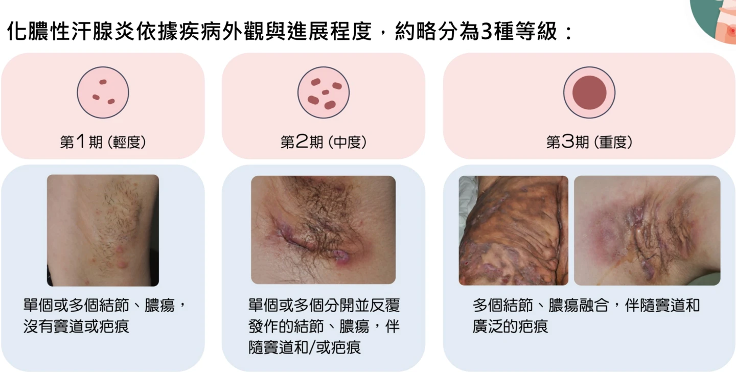 化膿性汗腺炎輕度、中度、重度症狀。台灣皮膚科醫學會提供