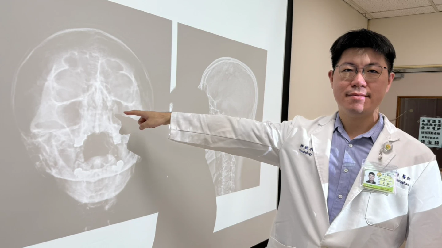 「鼻竇頭痛」常見的疼痛位置分散在雙眼上下與鼻腔周邊。臺中醫院提供