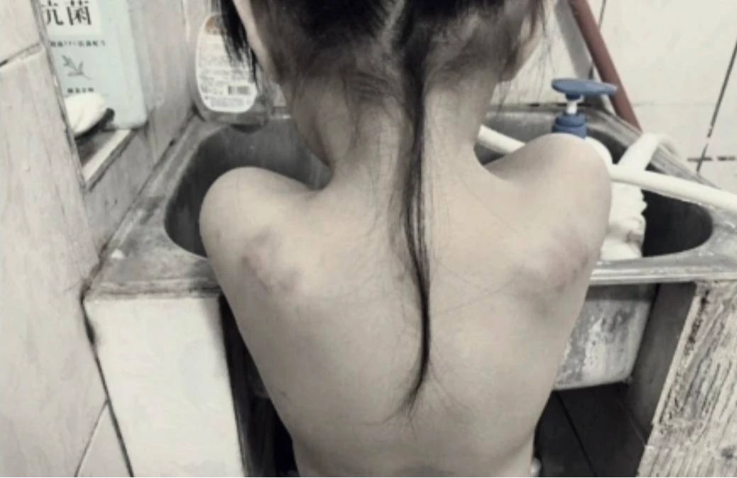 女童背部出現瘀青。翻攝畫面