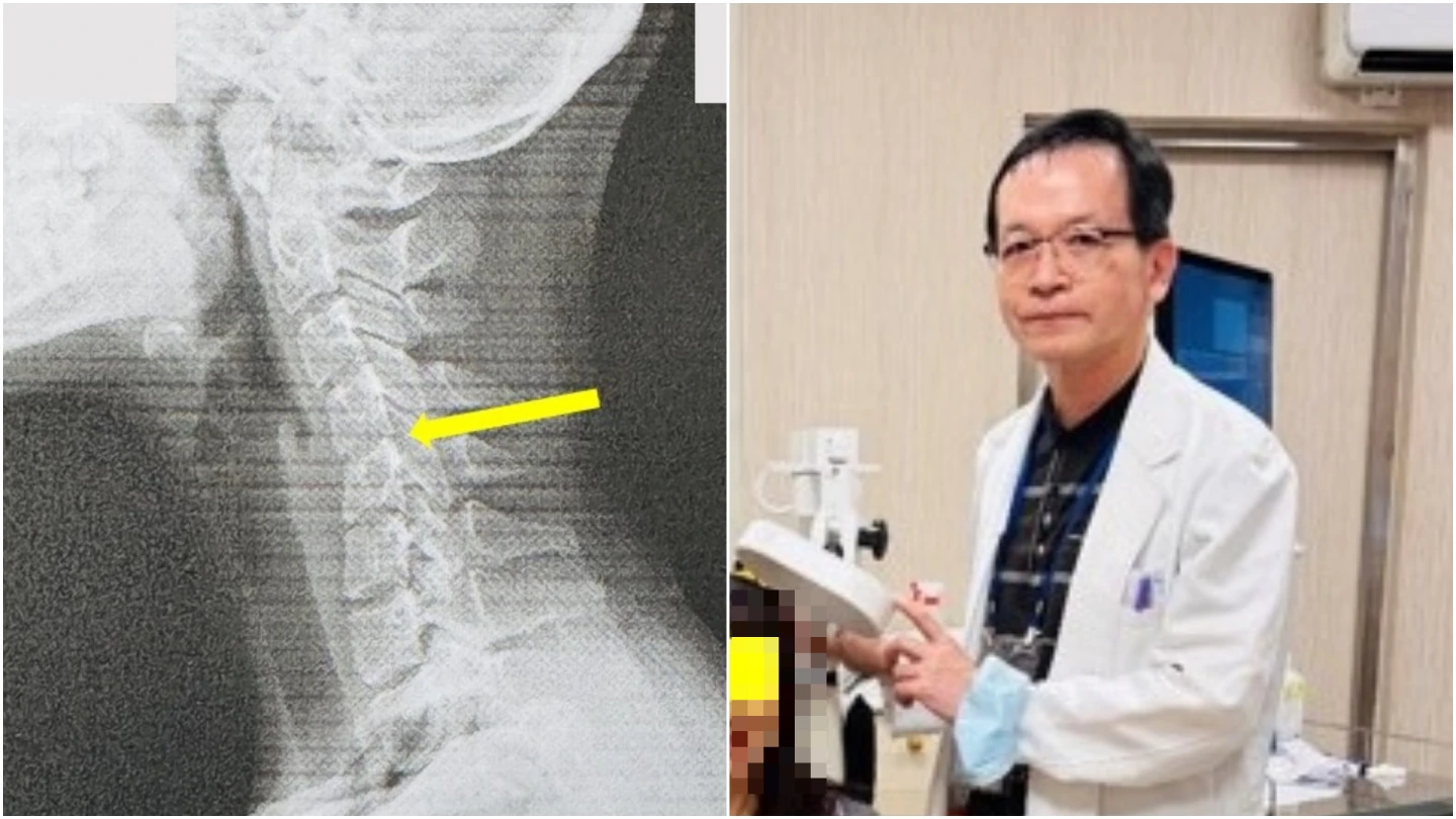 員榮醫院腦神經內科醫師葉宗勳(右圖)表示,一名20歲女性患者長時間低頭「滑手機」,造成頸椎退化,X光檢驗顯示她頸椎結構變形(左圖黃色箭頭處),如同60歲長者。取自FB@員榮醫院腦醫葉宗勲醫師