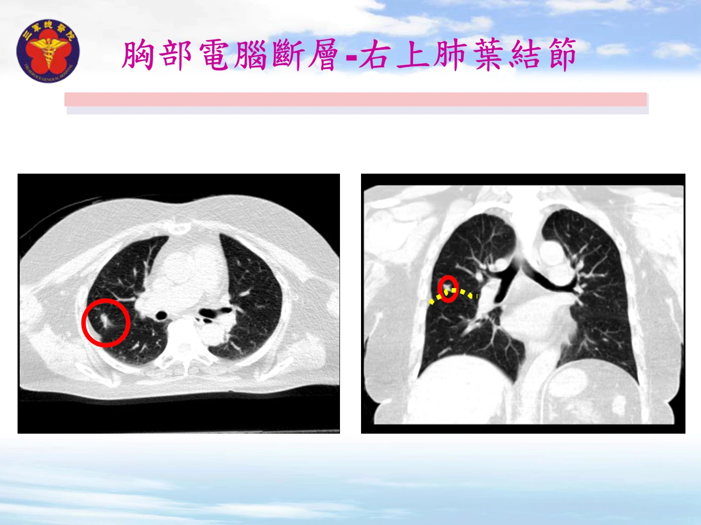 李女士右上肺葉出現約1.5公分毛玻璃結節。三總提供