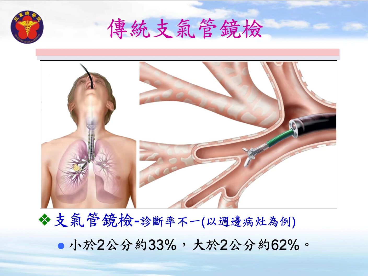 傳統支氣管鏡檢診斷率不一。三總提供