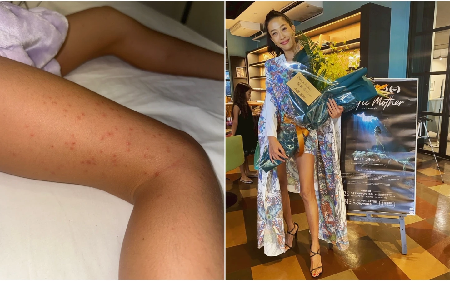 日籍女星福本幸子(右)指控,她與2名孩童入住日月潭雲品溫泉酒店,卻遭到床蝨(臭蟲)叮咬,導致3人皮膚滿是叮咬過敏腫包。取自FB@福本幸子