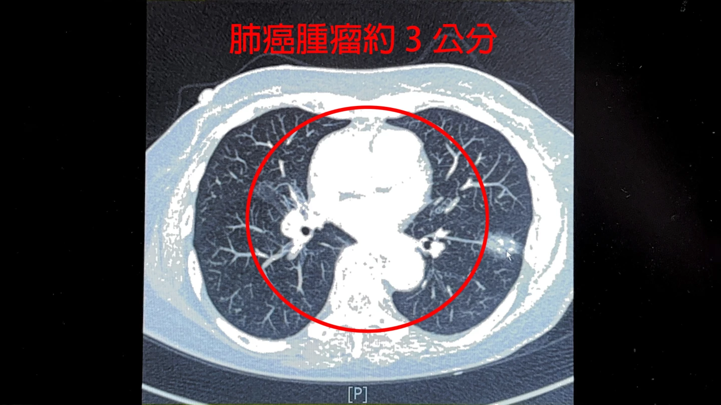 75歲女性不菸不酒,但曾在十多年前感染肺結核,今年健檢發現左下肺葉有一顆3公分大的肺癌。中醫大新竹附醫提供