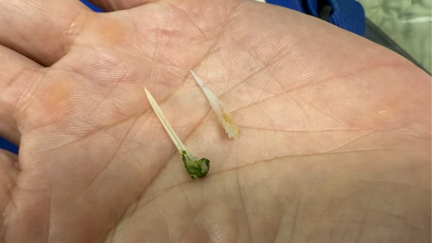 患者魚刺卡在食道,一度誤認為心肌梗塞。臺中醫院提供