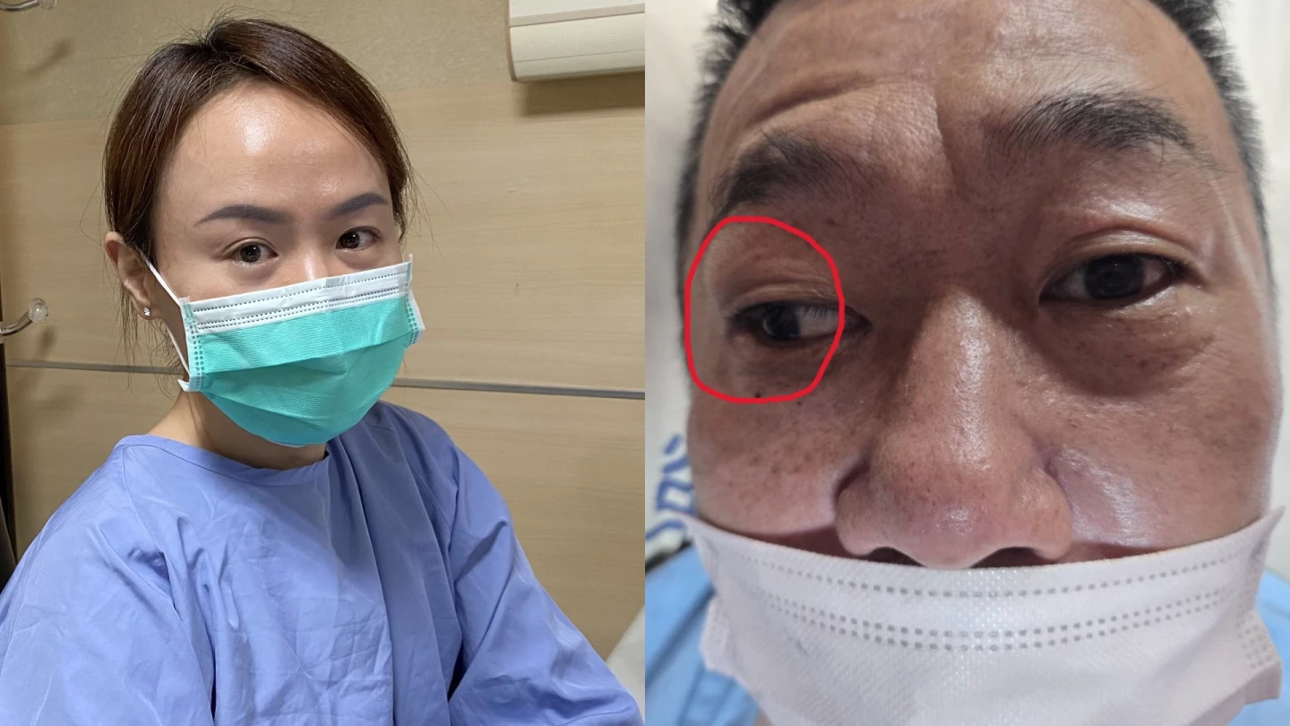黃先生的左眼可正常轉動,右眼球(紅圈處)卻偏向外側,陳彥秀醫師(左)診斷為左側腦幹缺血性中風。員榮醫院提供