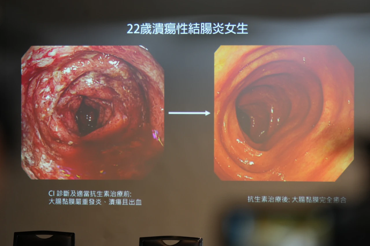 一名罹患潰瘍性結腸炎的22歲女性,兩年來飽受劇烈腹痛、頻繁腹瀉與血便困擾,由長庚醫院揪出致病原因是無毒梭菌作祟。李柏毅攝