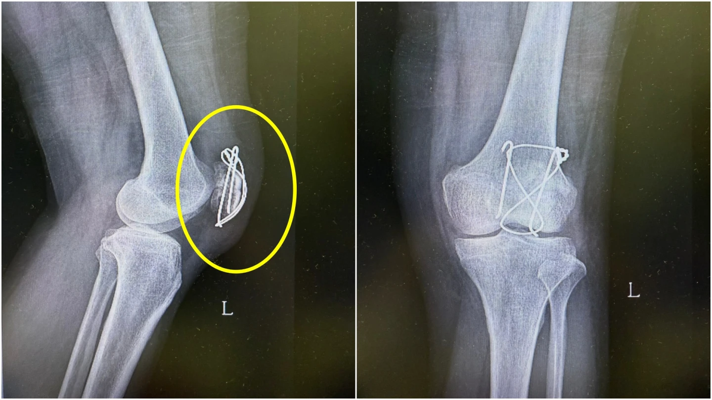 女被路口釘子絆倒骨折！吉安鄉公所遭判賠52萬　鄉長：概括承受