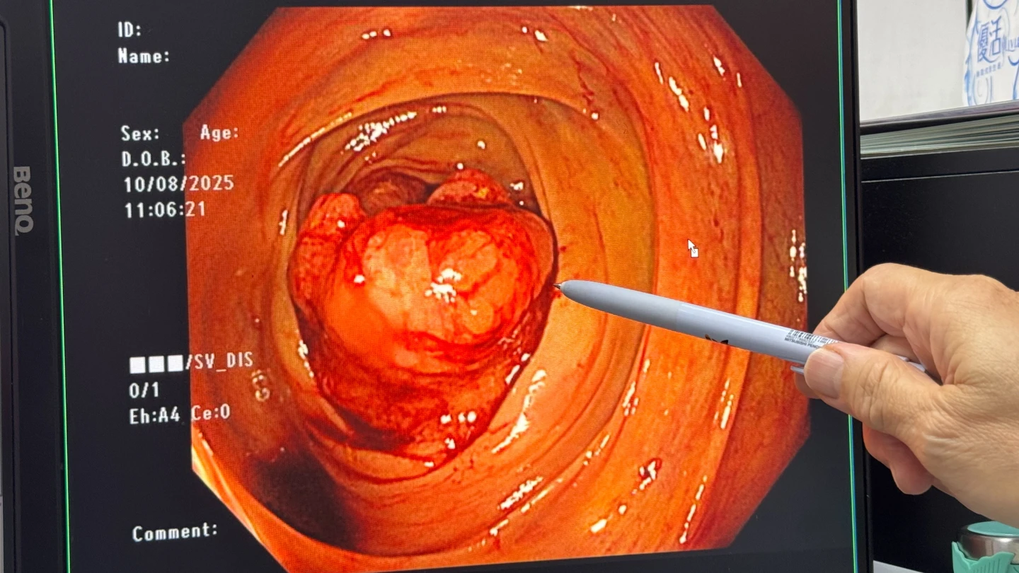 排便異常要注意！7旬婦頭暈送醫　竟查出大腸癌、胃出血雙重危機