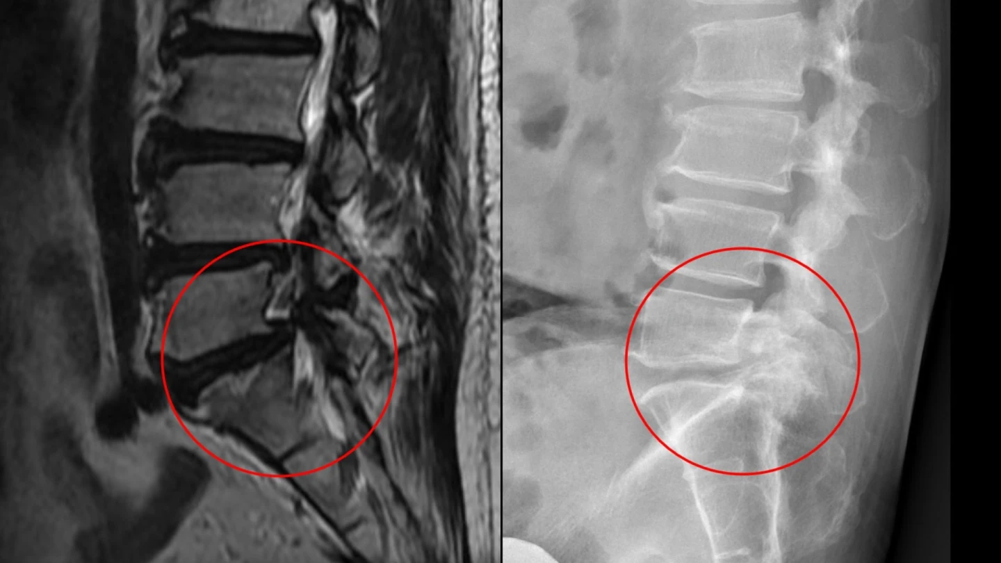 脊椎關節長滿痛風石　男子劇烈腰痛一年誤當工作疲累