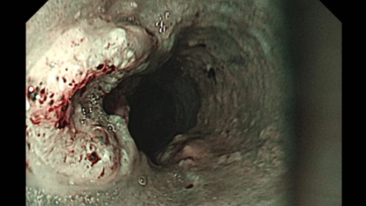 菸酒檳不忌慘了！中年男吞嚥不順罹2癌　加工食品、熱湯也少吃