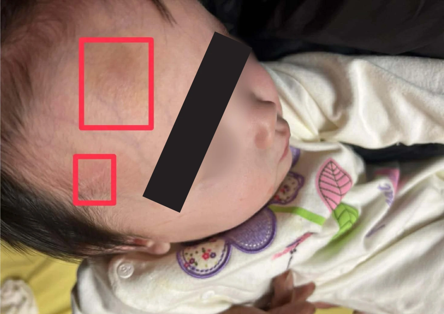 剴剴翻版！1歲童頭臉瘀青社工竟稱「蚊子叮」又改口　母崩潰怒告