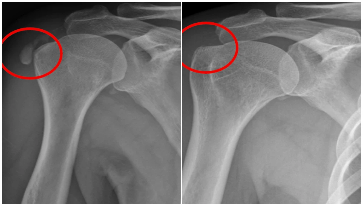 肩膀卡卡、睡覺翻身痛醒！當心肩鈣化性肌腱炎　長庚AI預測療效
