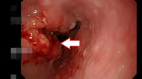 不是胃食道逆流！58歲男胸口灼熱、喝水卡卡竟罹食道癌　醫示警致命習慣