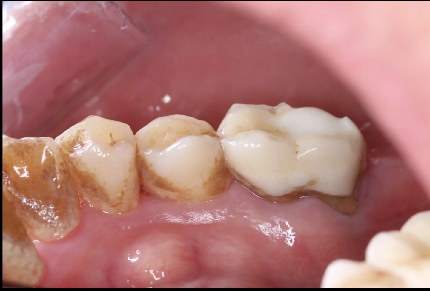 正確刷牙比次數重要！忙碌女主管齒槽骨吸收　才知牙周病惡化