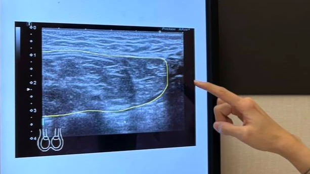 鼠蹊部腫一塊別硬撐！腹股溝疝氣恐致腸壞死　醫籲摸到腫塊儘速就醫