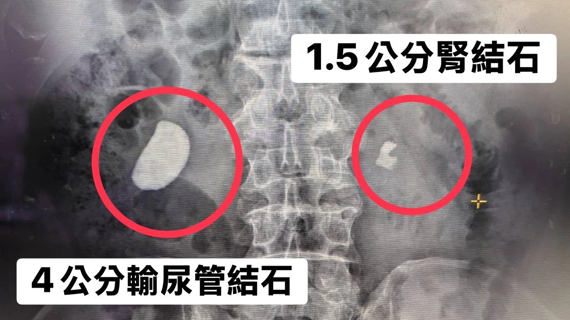 罕見病例！細小輸尿管竟卡4公分結石　「血尿」救了勇健退休男　