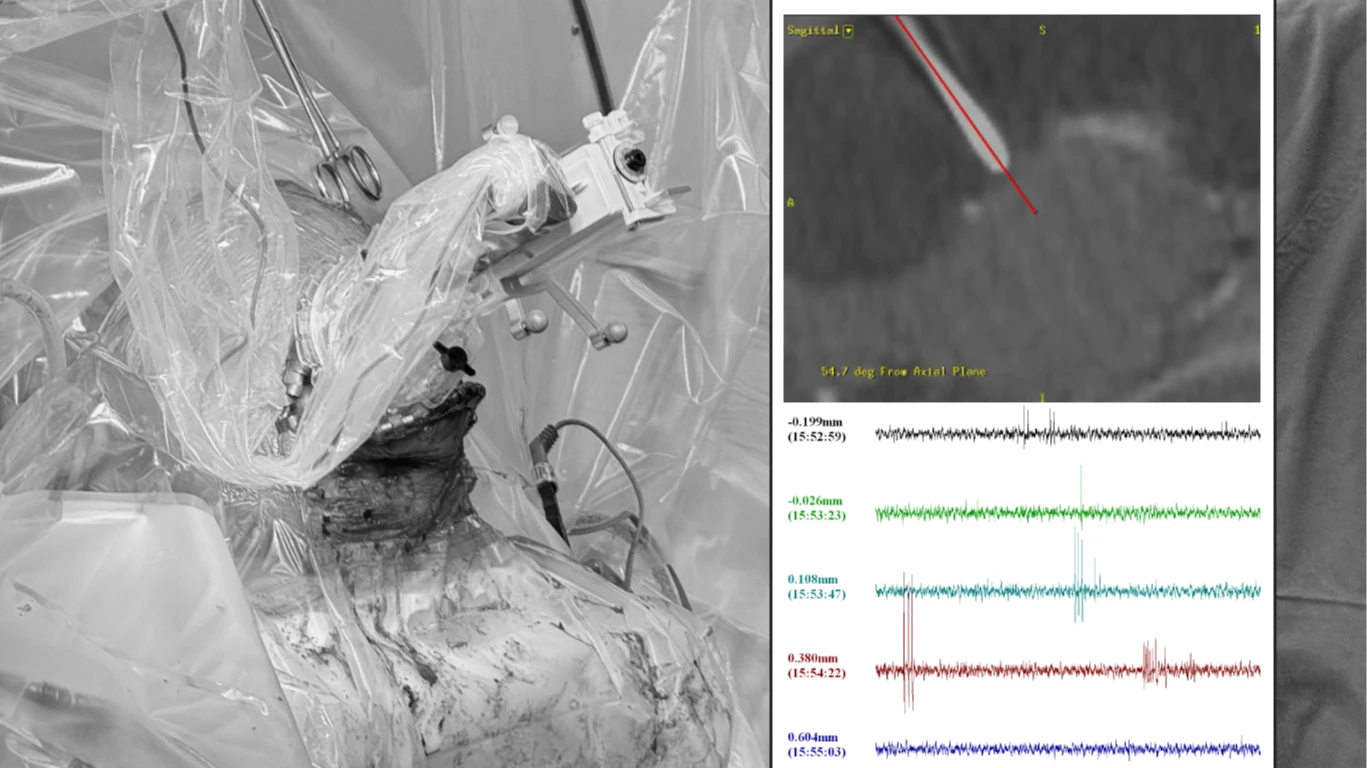 20歲男每月癲癇發作傷智力　台大新型深腦刺激術助走出陰霾