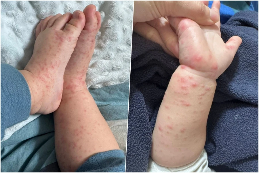 離譜醫隱匿女兒腸病毒！稱「以為濕疹」釀國小4班、11童感染　高市府開鍘最重罰30萬