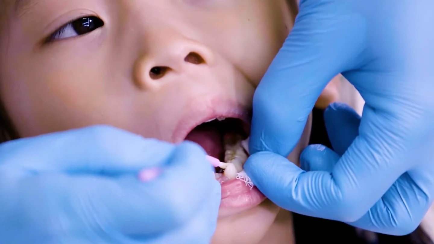 寒假大吃甜食當心蛀牙！　台北市免費牙齒塗氟將開跑