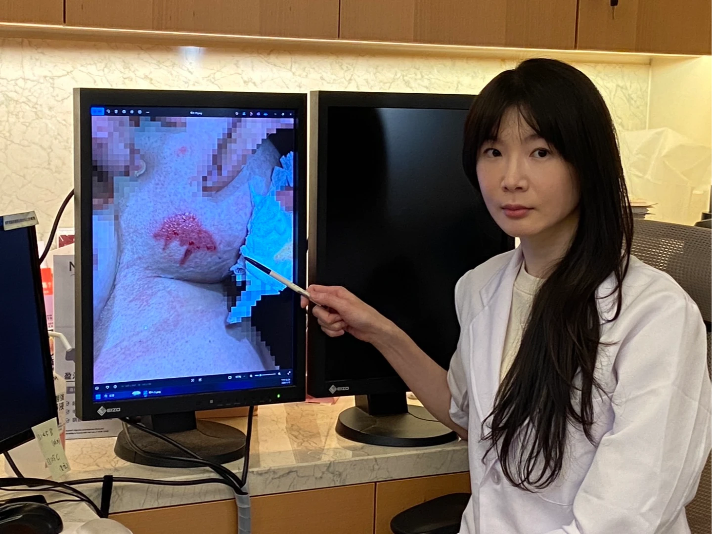 暖暖包禦寒注意！5旬婦塞胸口一整天　竟燙傷「皮膚整片剝落」