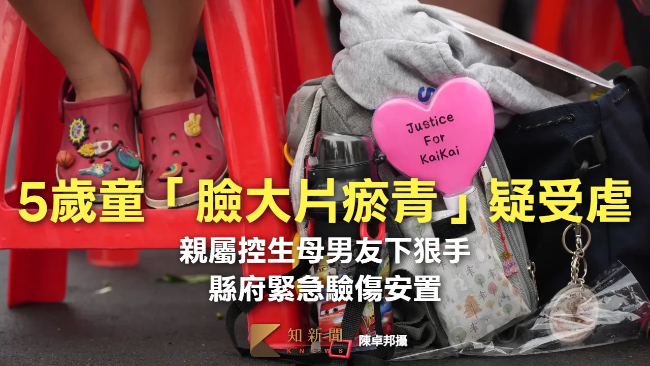 宜蘭5歲童「臉大片瘀青」疑受虐！親屬控生母男友下狠手　縣府緊急驗傷安置