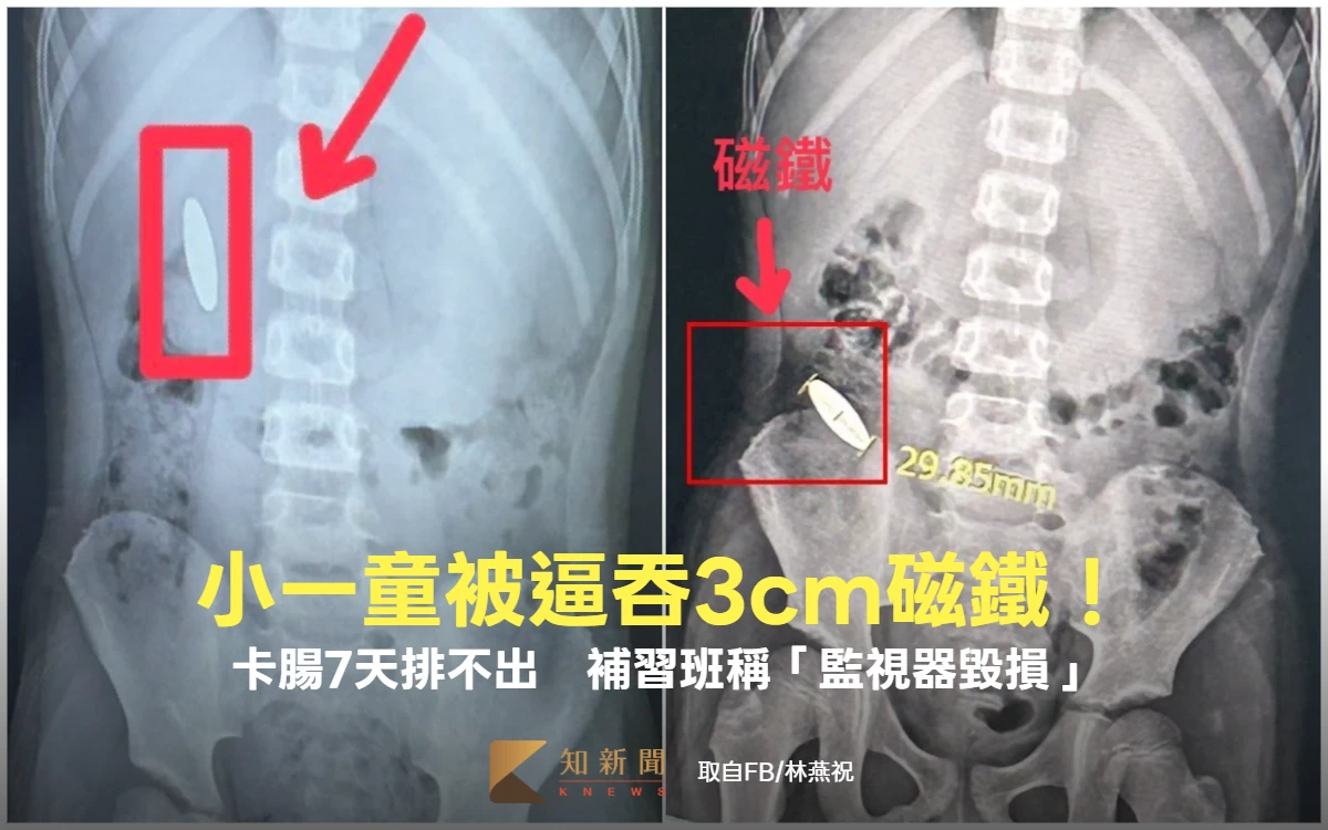 小五童逼小一生吞3cm磁鐵卡腸！補習班稱「監視器毀損」　教育局揭離譜3缺失開罰