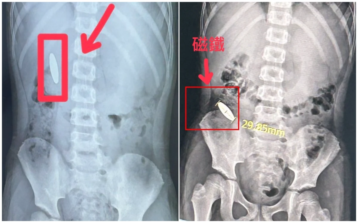 小五童逼小一生吞3cm磁鐵卡腸！補習班稱「監視器毀損」　教育局揭離譜3缺失開罰