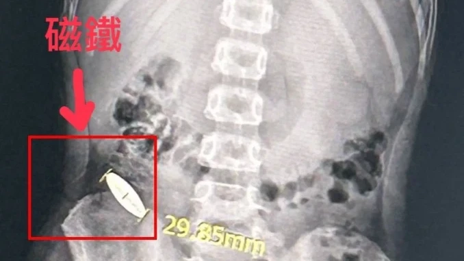 小一生被逼吞磁鐵「卡腸7天排不出」！　醫示警：嚴重恐腸穿孔、腹膜炎