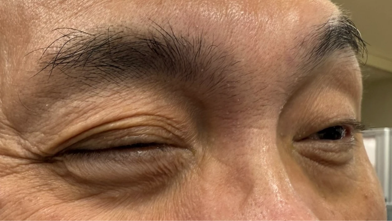 有片｜右眼皮狂跳3周「以為要出事」！6旬男憂中風急就醫　醫揭常見原因