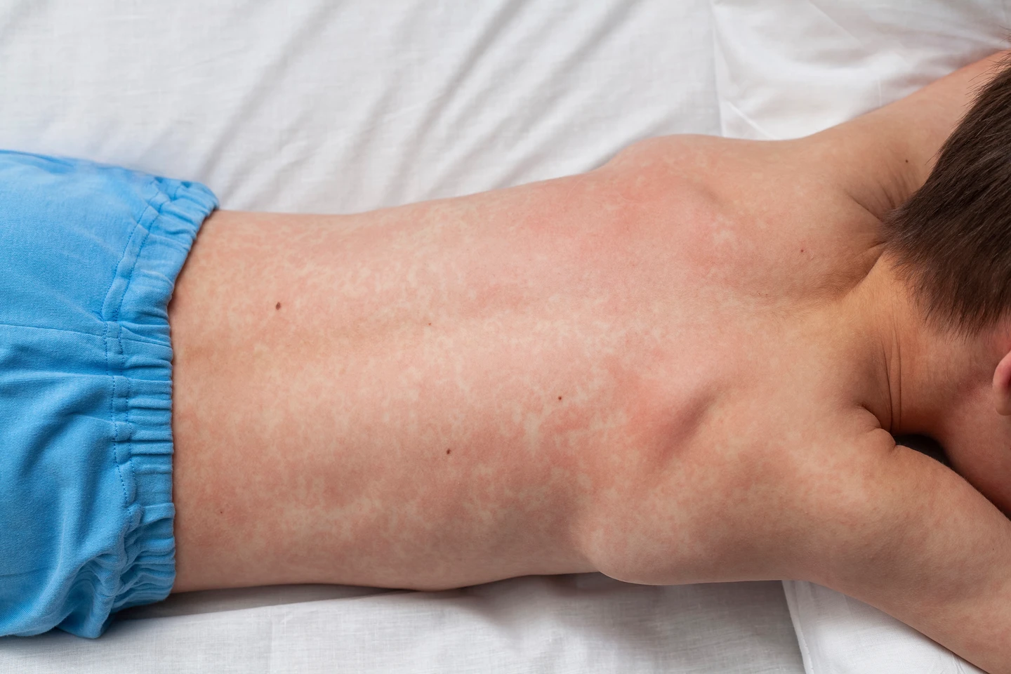 赴日旅遊小心！醫點名20至45歲國人　麻疹抗體保護力最不穩