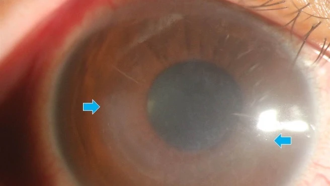 青春期到30歲是圓錐⾓膜高風險！　散光狂飆別輕忽