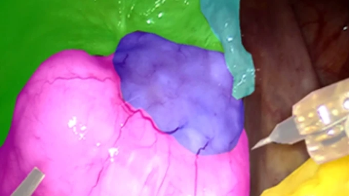 台科大攜手三總打造AI「第二雙眼」　助降達文西手術誤傷風險