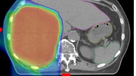 60歲婦肝腫瘤15⭢6公分、2年未復發　林口長庚質子合併免疫治療助攻