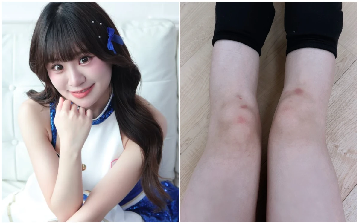 中職｜啦啦隊女神深夜PO雙膝照！證實「半月板、韌帶撕裂傷」恐將停工