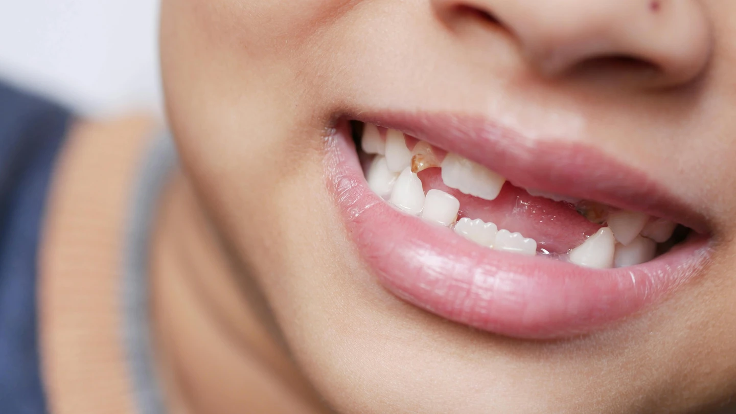 小五童在校跌倒門牙整顆脫落！　爸媽靠「咖啡牛奶」＋黃金時間成功接回