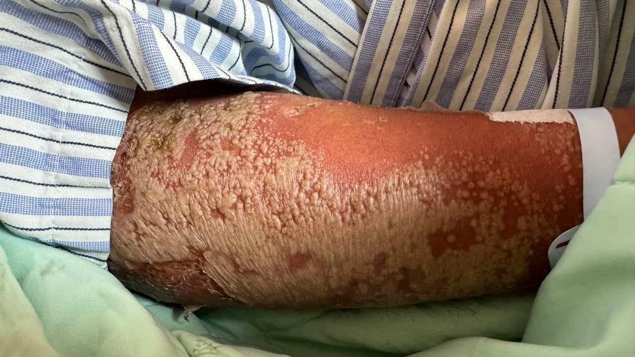 慎入！染新冠肺炎引爆全身膿疱乾癬　醫揭全球罕見關鍵原因