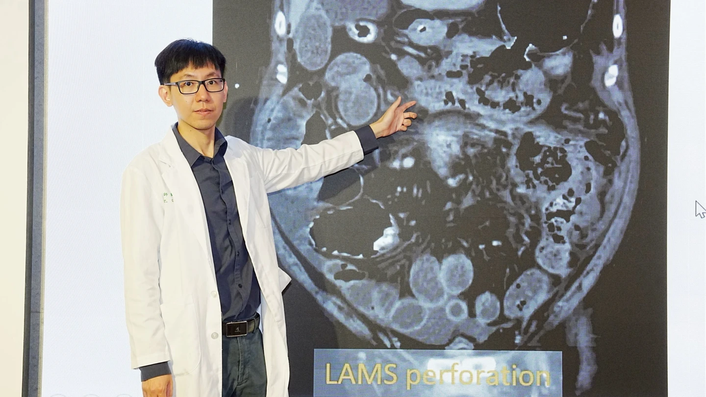 39歲男腹痛以為胃脹氣！竟是膽結石惡化險死　醫曝壞死性胰臟炎危機