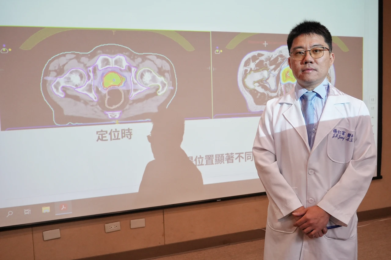 攝護腺癌放療40次減至5次　磁振刀精準定位避免傷膀胱、直腸
