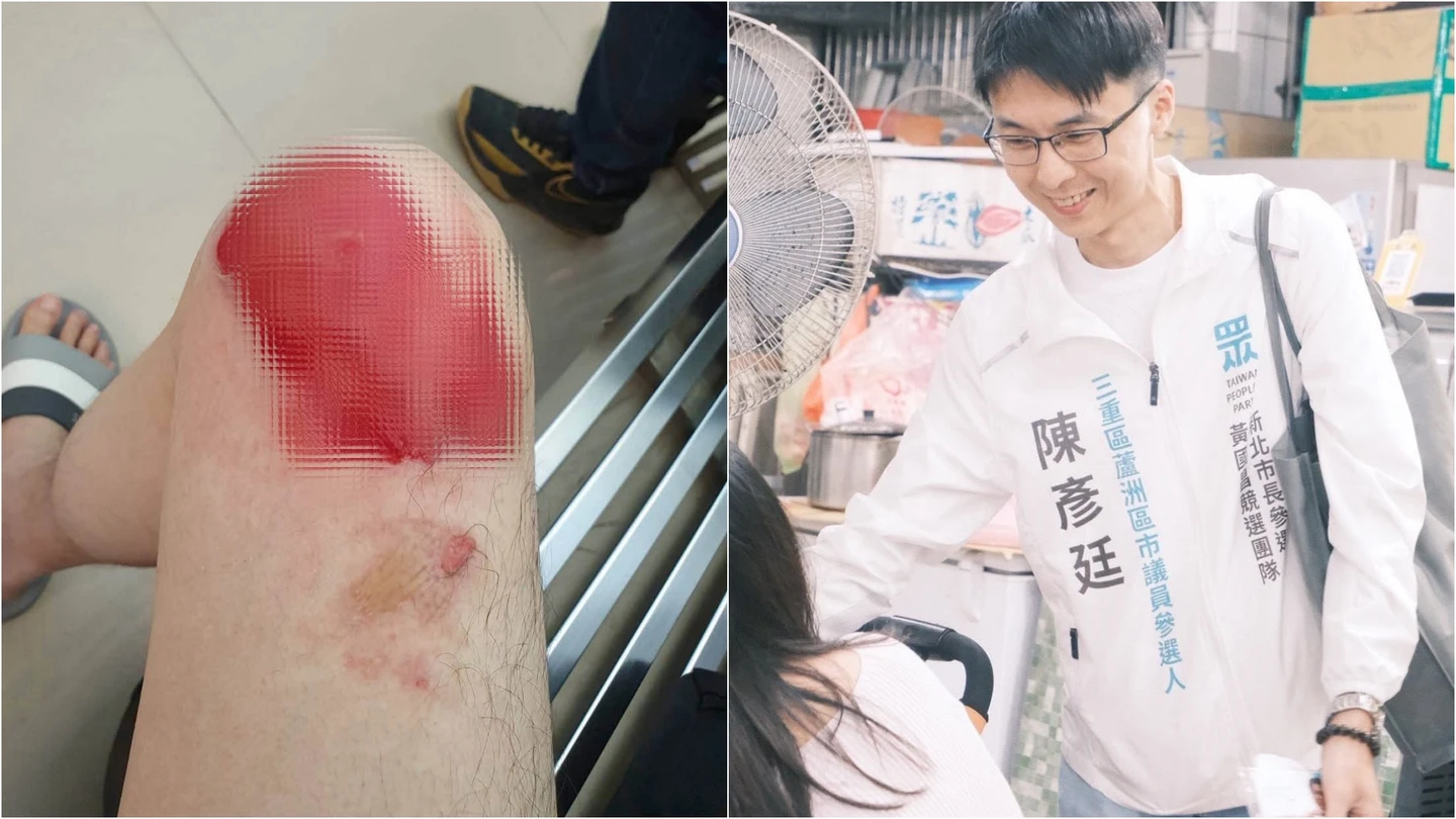 最強「家樂福員工」選議員！大面積燙傷暫停行程　照片曝光網看傻：太嚴重
