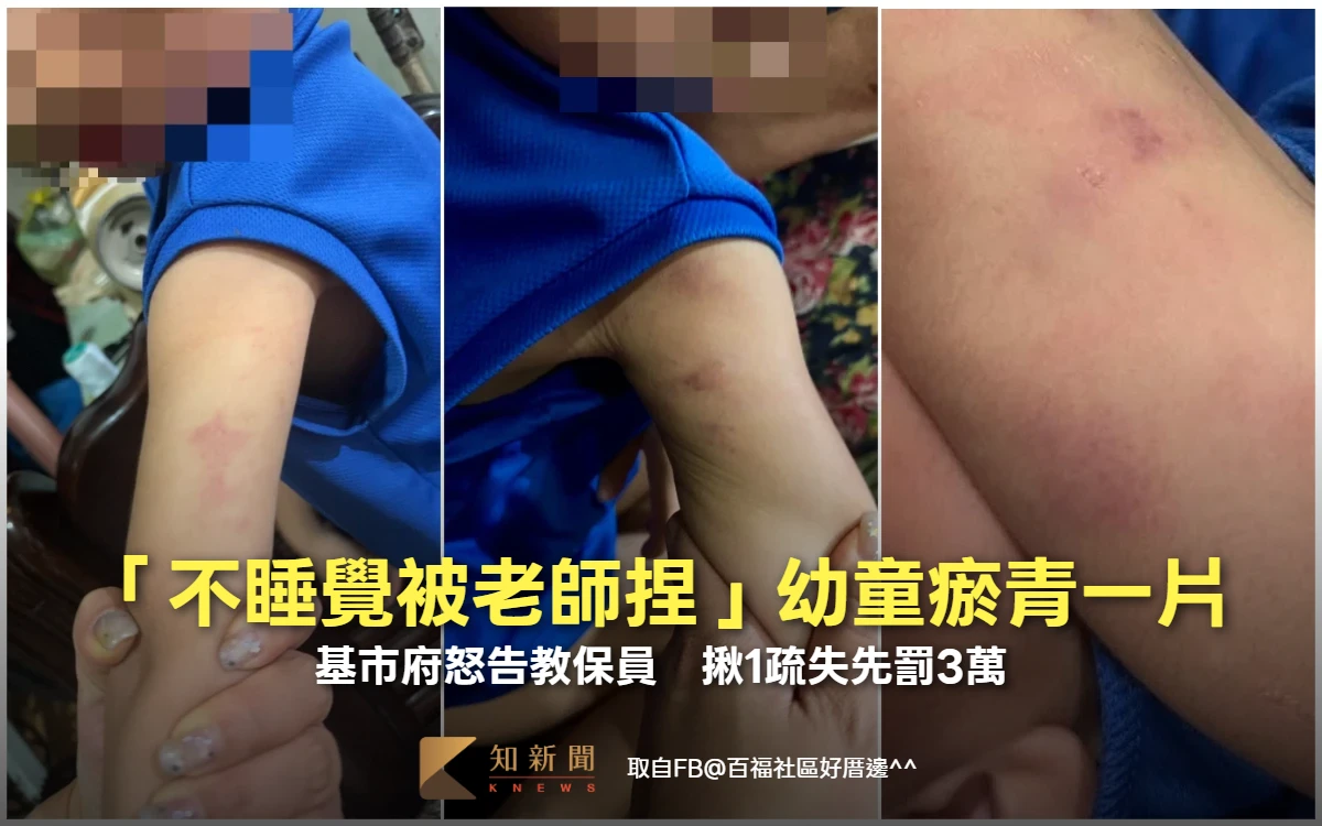 「不睡覺被老師捏」幼童瘀青疑受虐！基市府怒告教保員　揪1疏失先罰3萬
