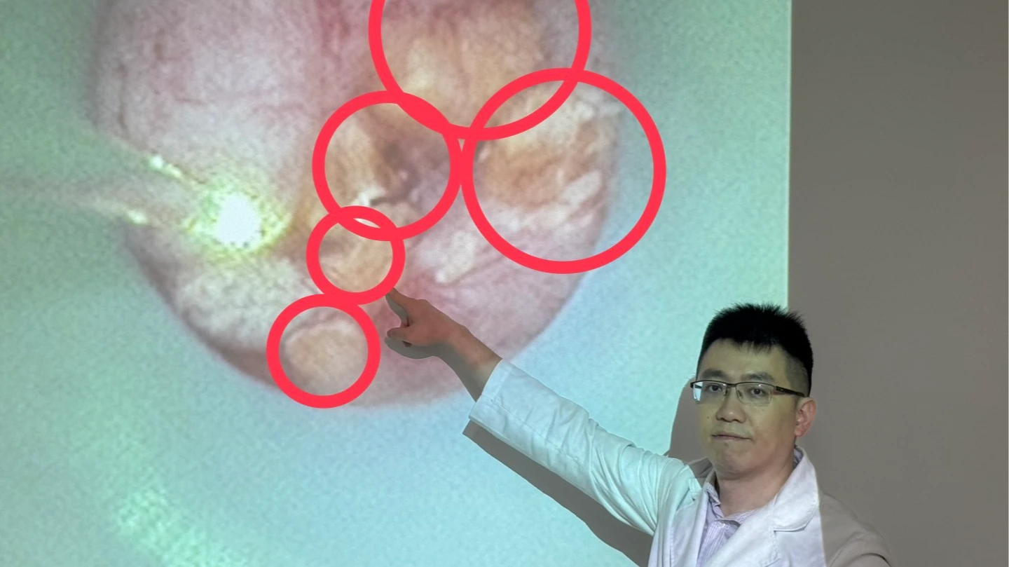 沉迷追劇忘喝水！台中婦5個月腎結石發作3次　雙腎宛如「葡萄乾雜糧麵包」