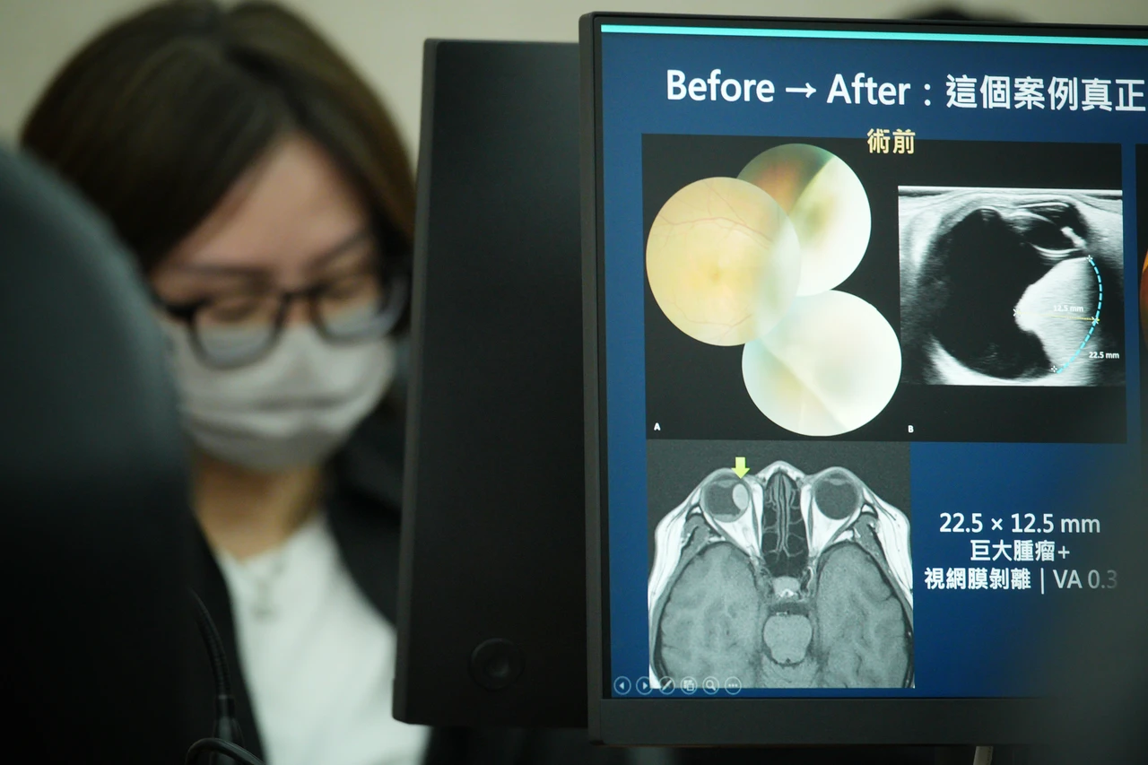 36歲女眼內巨大黑色素瘤　北榮神手術保住眼球、恢復視力